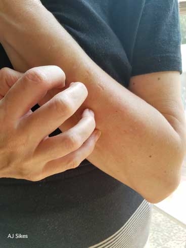 A person wearing a black shirt scratching their forearm.