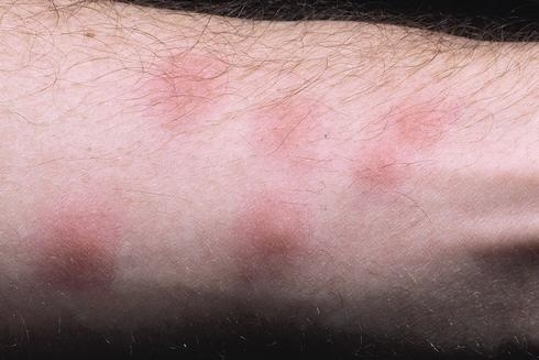 Bed bug bites cause swellings that become red and irritated when scratched. (Photo: Chet K. Fukushima)