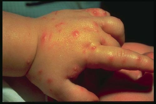 White pustules from red imported fire ant sting. (Credit: Texas Agricultural Extension Service)