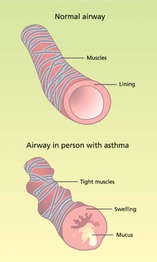 Asthma pathology. Source: NHLBI 2006.