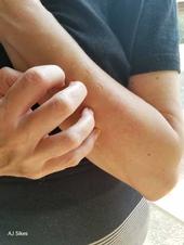 A person wearing a black shirt scratching their forearm.