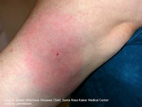 Early localized Lyme disease rash [G.M. Green]