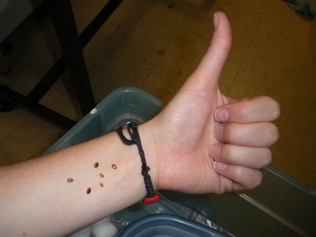 The arm of Danielle Wishon and her bedbugs, feeding.