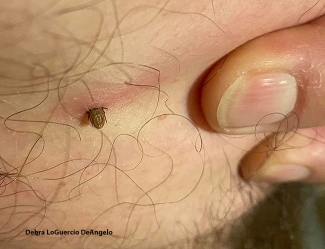 This is the tick buried in the skin of Winters' resident Joe Nazarius. It's black-legged nymph tick, Ixodes pacificus, as identified by Lynn Kimsey, director of the Bohart Museum of Entomology and a UC Davis distinguished professor of entomology. (Photo by Debra LoGuercio DeAngelo)