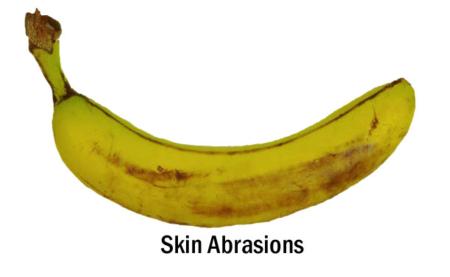 Skin Abrasions