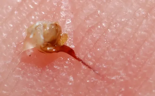 Here's a close-up of what the stinging apparatus looks like in the skin. (Photo by Kathy Keatley Garvey)