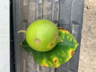 edema