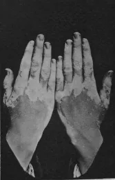 Leucoderma, aka vitiligo, white leprosy, or piebald in old English literature